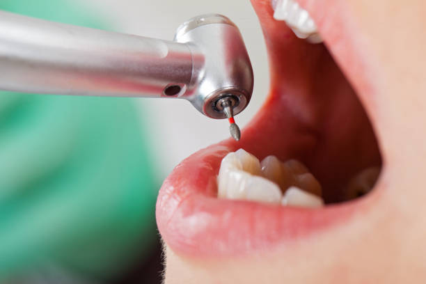 Best Chipped Tooth Repair Near Me  in Mont Clare, PA